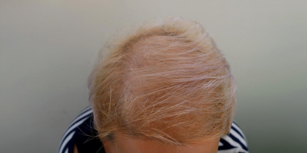 Sculp of woman with thinning hair